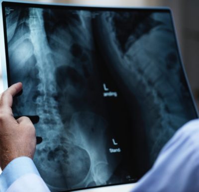 A doctor holding an x-ray of someone's spine.