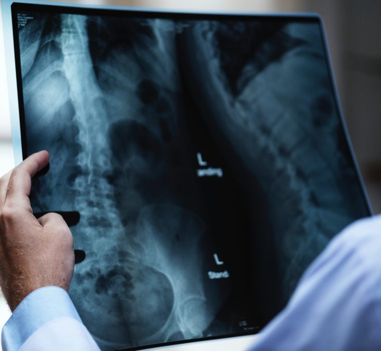 A doctor holding an x-ray of someone's spine.